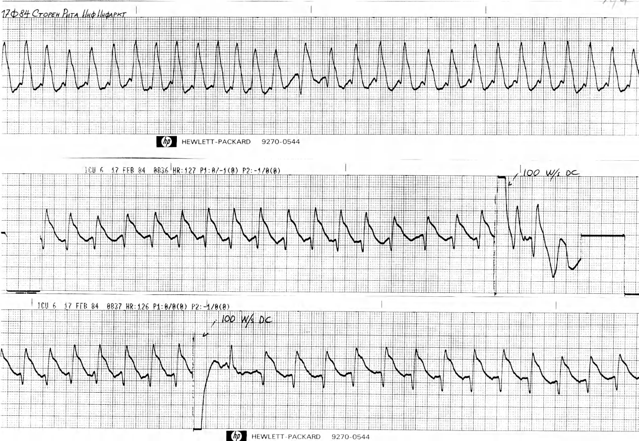 The top strip is in AF with a VEB, the middle one probable AF & sinus tachycardia, the bottom one establishes sinus rhythm after a possible VEB. The staff believed theywere shocking a VT. 