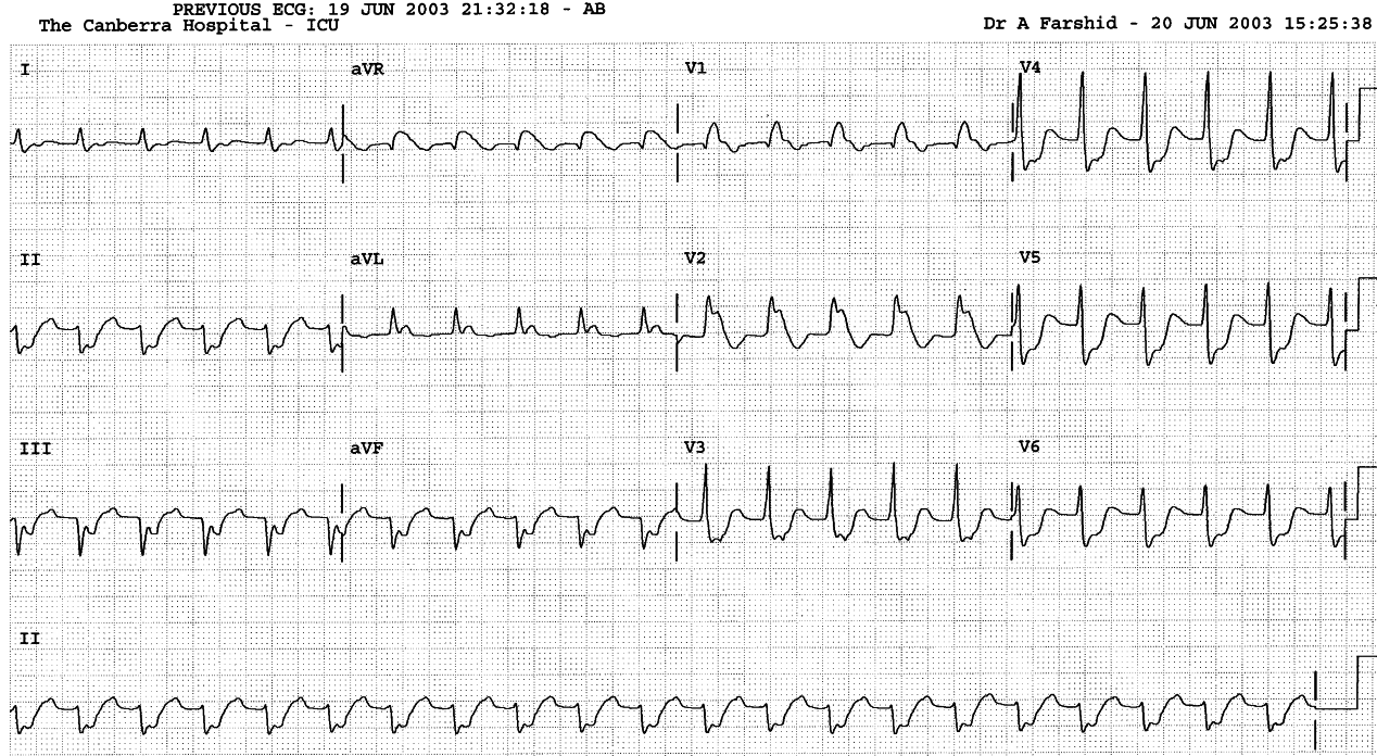 13 year old girl with chest pain