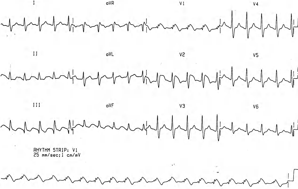 Lead V1 still shows some T wave alternans post-intubation. It resolved within minutes of this ECG being taken. 