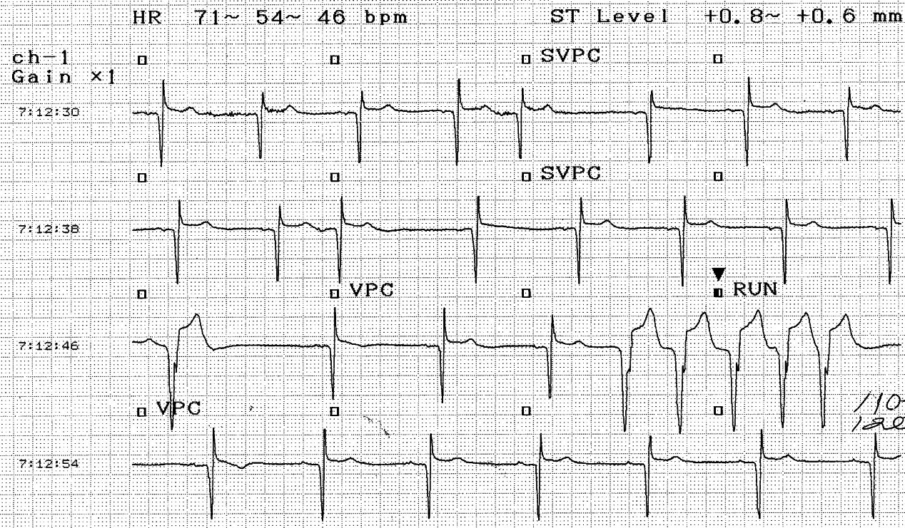 Pauses followed by flat or inverted T waves.