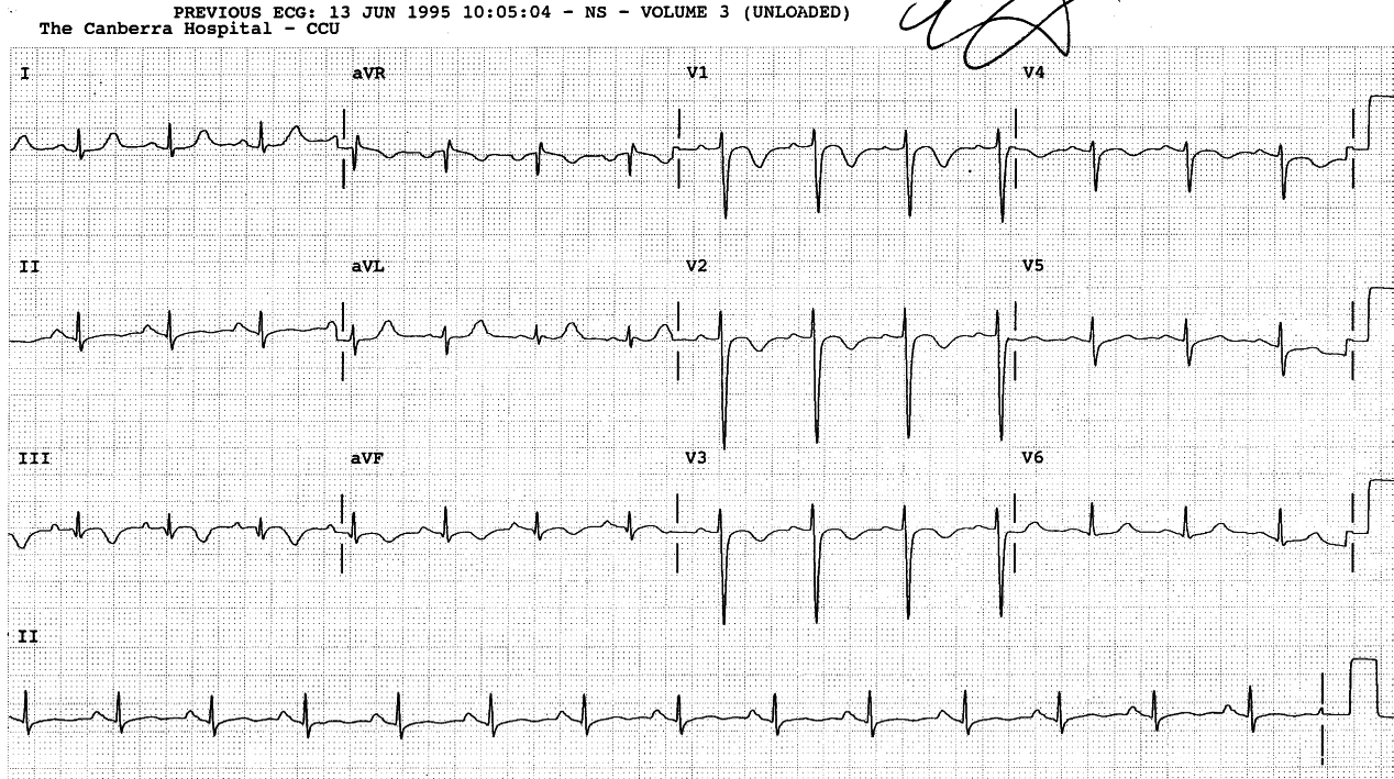 Obese 65 year old lady with sudden onset of breathlessness