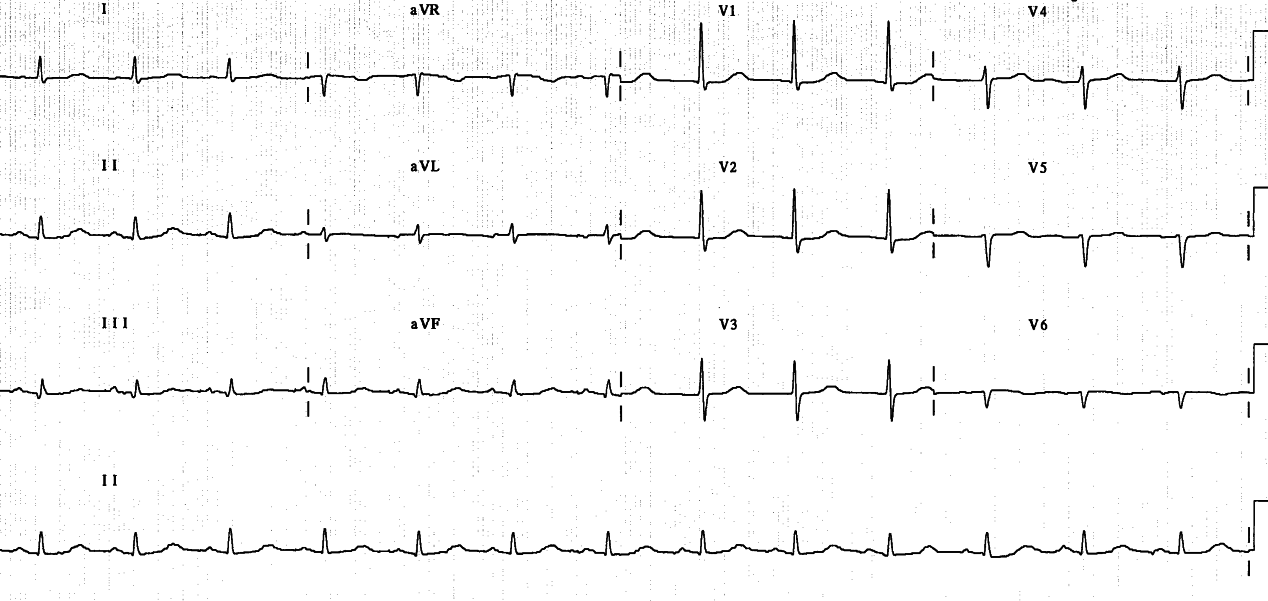 Routine ECG on a 65 year old lady with no evidence of heart disease