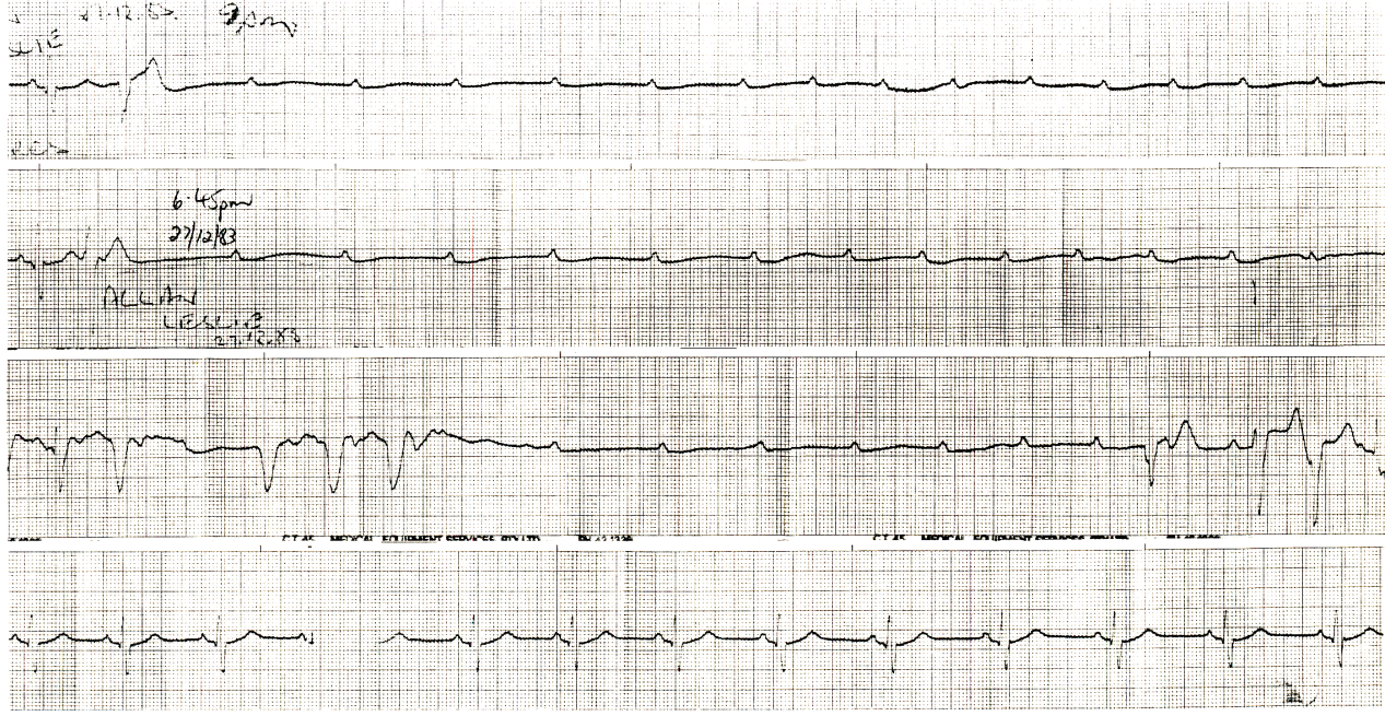 60 year old man with syncopal attacks. What could be the     proximate cause of the heart block here? 