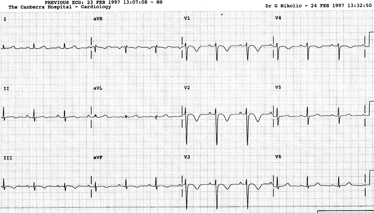 No S in lead 1, no Q in 3. Precordial T inversion comes later but lasts much longer.