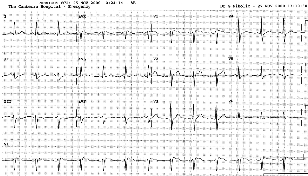 60 year old man with atypical chest pain in Casualty