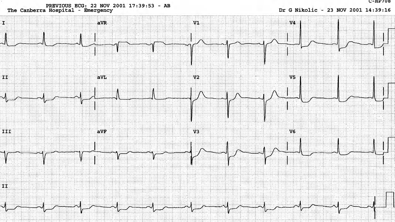 The âplaneâ ST segment depression is a classical response to ischÃ¦mia. But not in this case. 