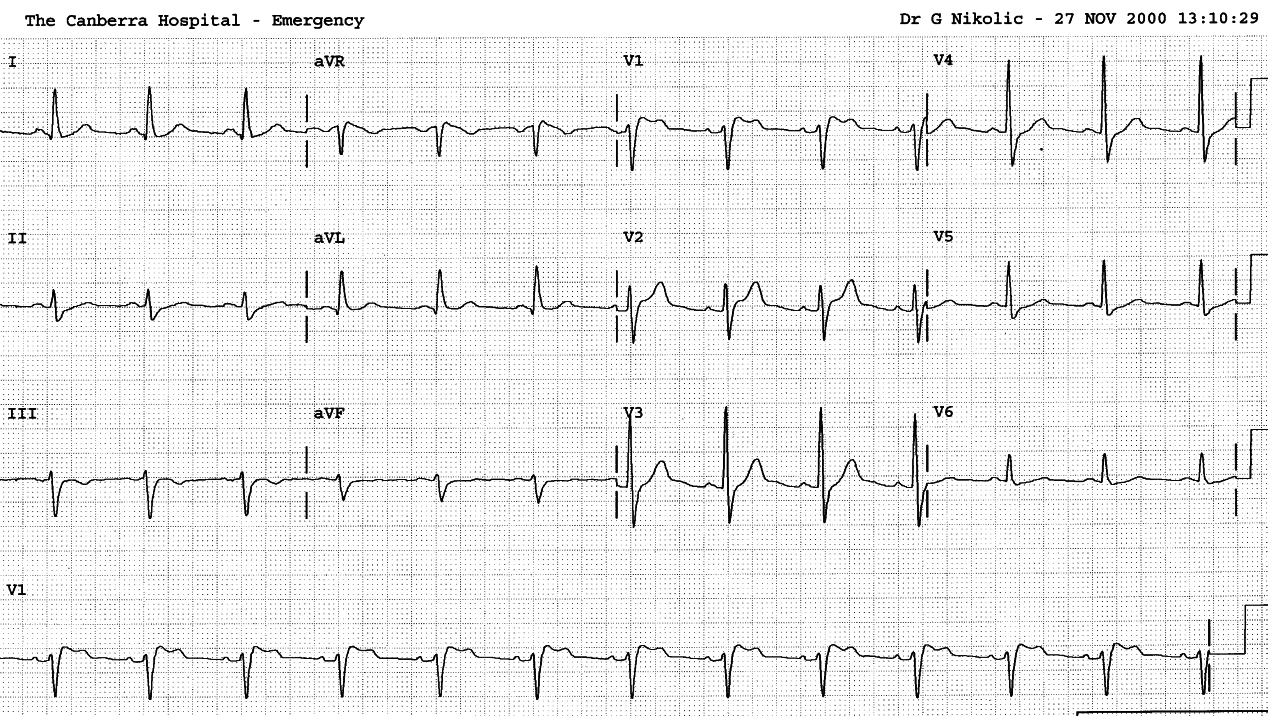 Repeat ECG barked at the wrong tree (septal ischÃ¦mia), but at least allowed the patient to go home.