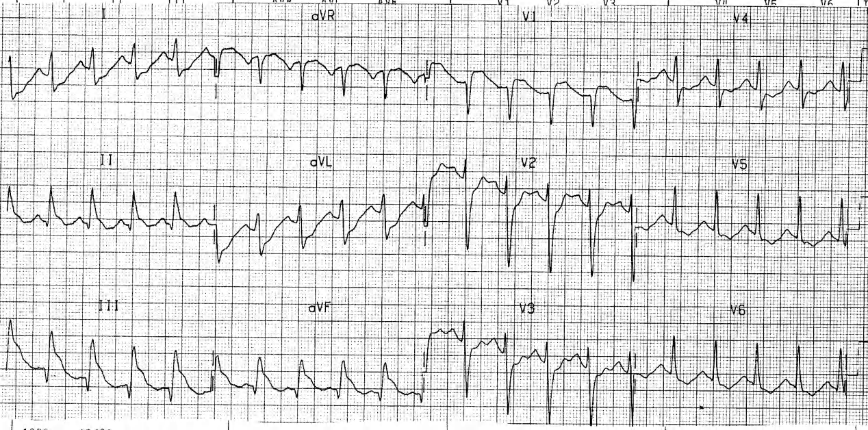 Sinus tachycardia and RV infarction (inferior MI + ST elevation, rather than depression, in V1). 