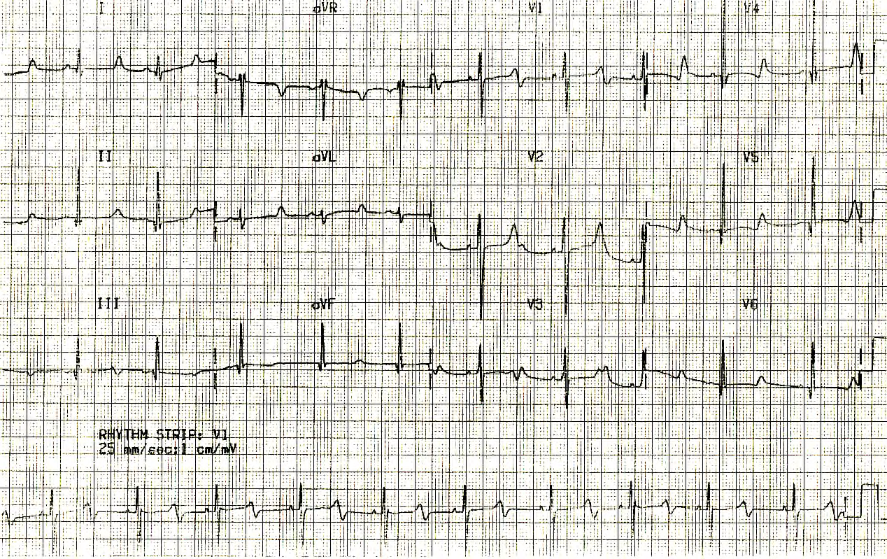 Asymptomatic 12 year old boy with strong family history of sudden death, about to visit Australia.