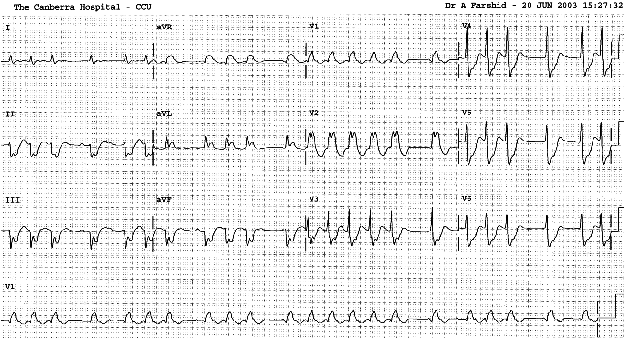 Broad complexes and repolarisation shifts make atrial activity difficult to track.