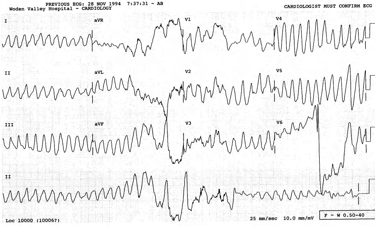 48 year old man on chronic hÃ¦modialysis programme, using sotalol for (or, rather, against) intermittent atrial fibrillation. 