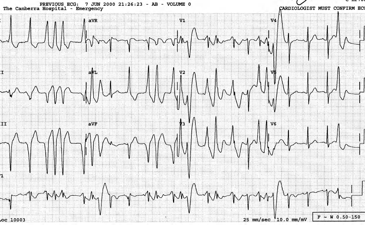 52 year old man uncomfortable with âbutterfliesâ in his chest. There is no significant medical history. 