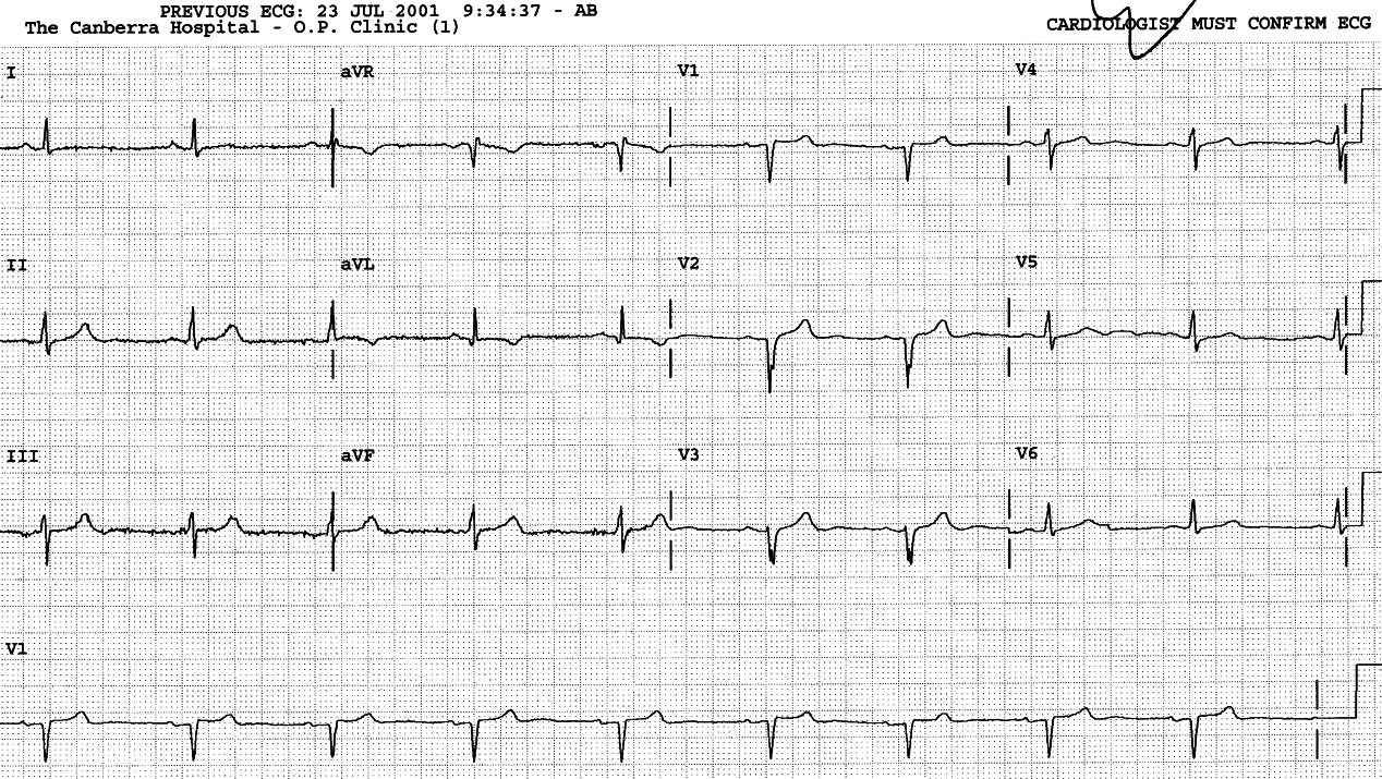 54 year old with crushing chest pain as he lit his first ever cigarette!