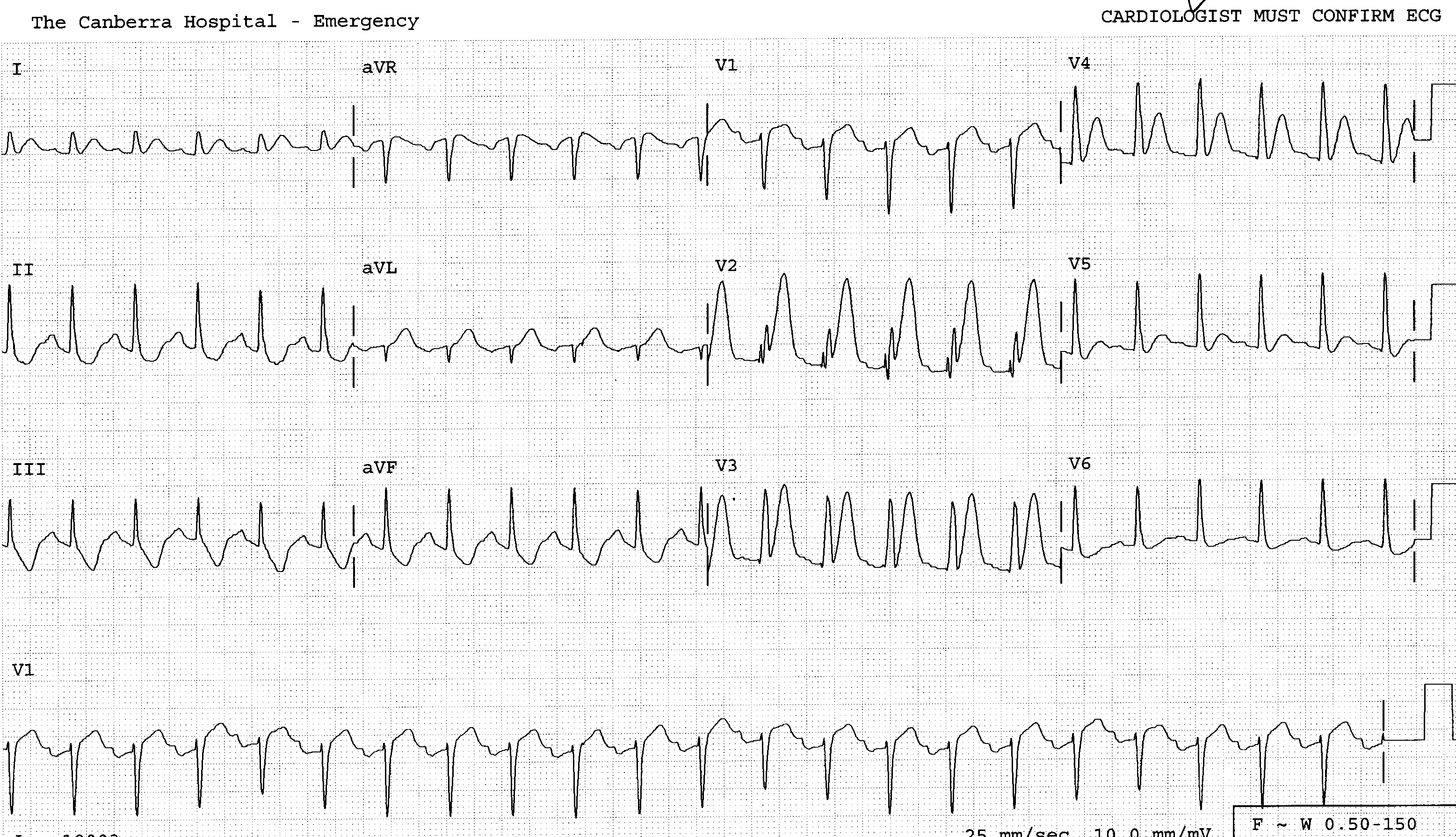 40 year old with chest pain. What coronary lesion is likely to have caused it?