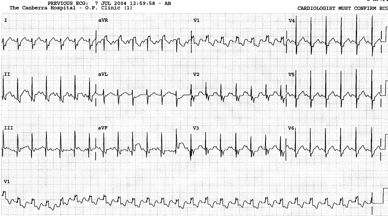 Six weeks old male infant investigated for cardiac murmur