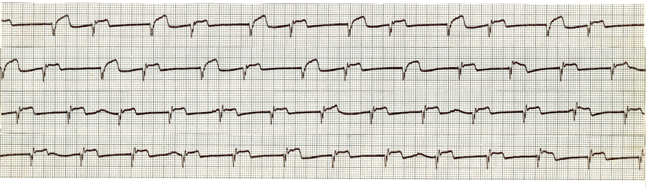 Same patient as Case 134, following the resolution of     bigeminy.  