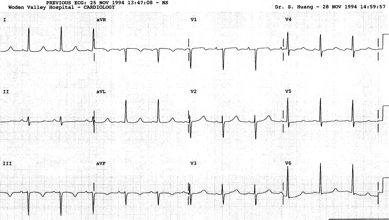 The T wave is relatively normal per se; the trace is, in fact, suggestive of hypocalcÃ¦mia in this hÃ¦modialysis patient. The corrected serum calcium was, however, normal. 