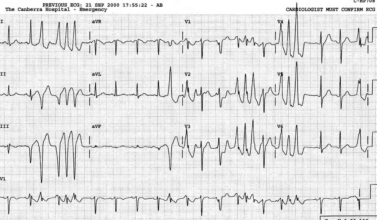 Persistent ventricular ectopic activity over hours in Casualty. 