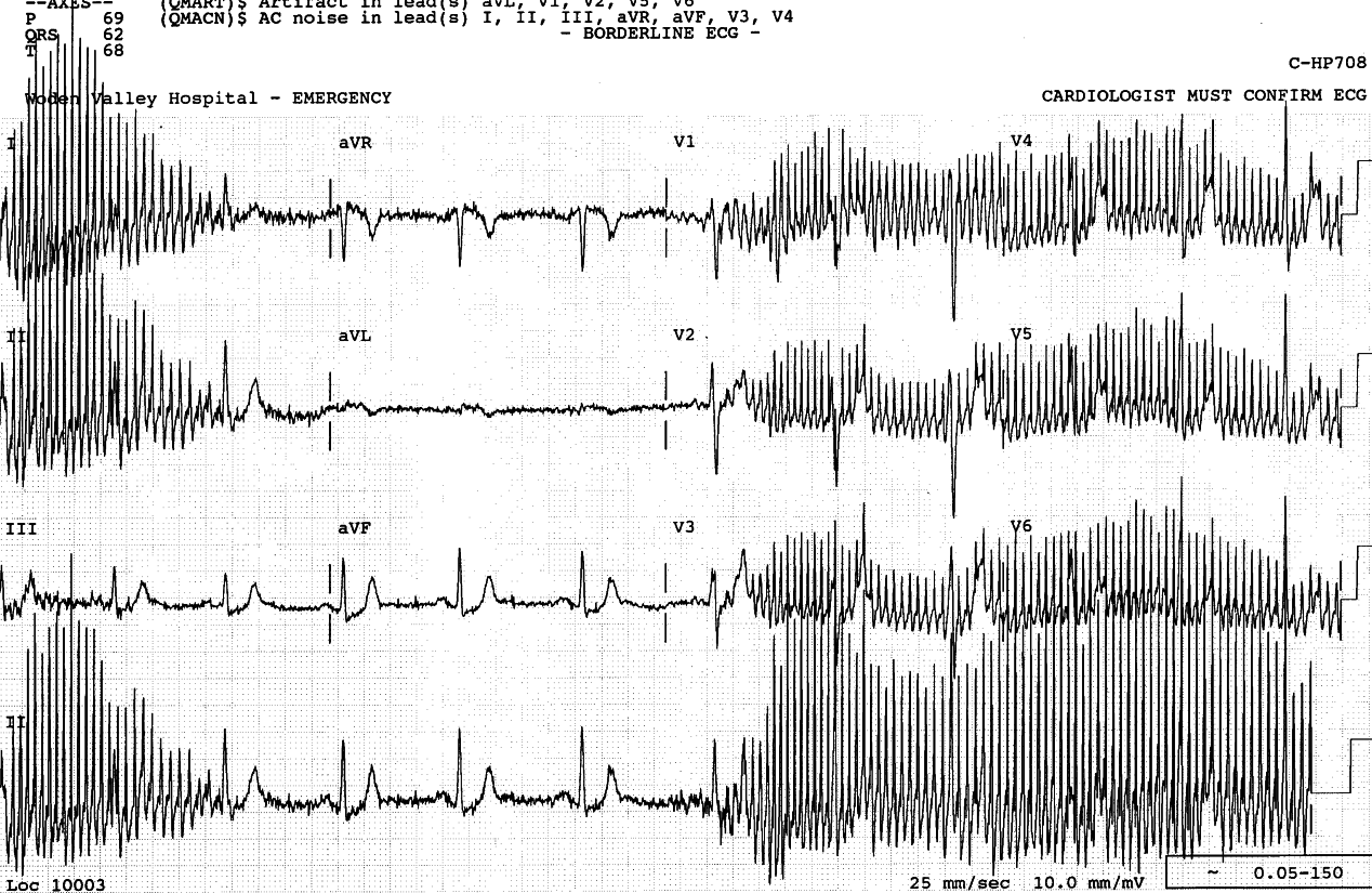 49 year old lady with spastic paraparesis from a remote subarachnoid hÃ¦morrhage. She lost consciousness after a fall from her wheelchair