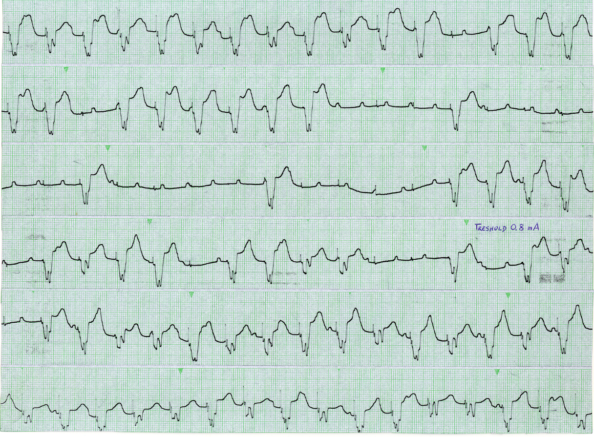 Size matters: small spikes fail to excite the     ventricle. Strips taken during treshhold determinations in the X-ray     Department. 