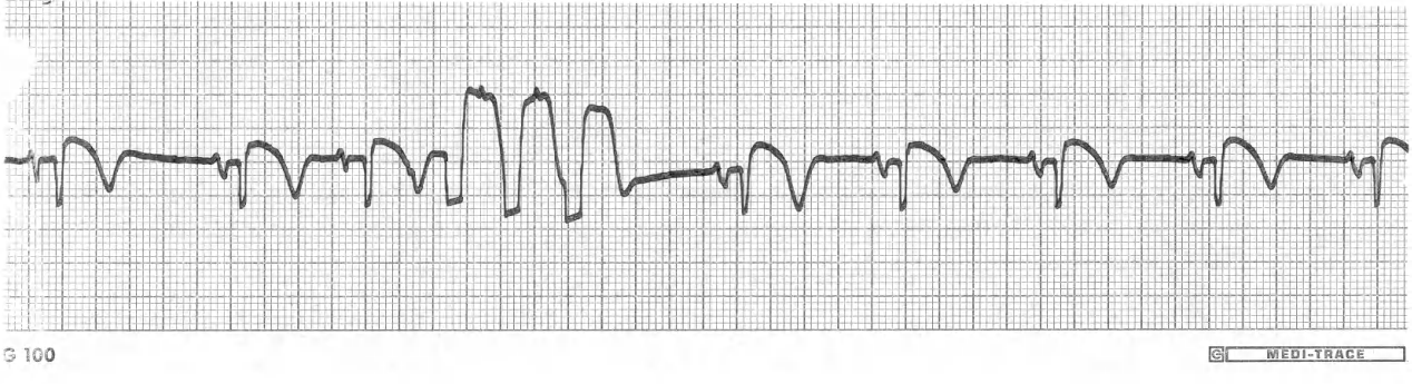 69 year old lady exposed to xylocaine (lidocaine) in a Massachusetts CCU. 