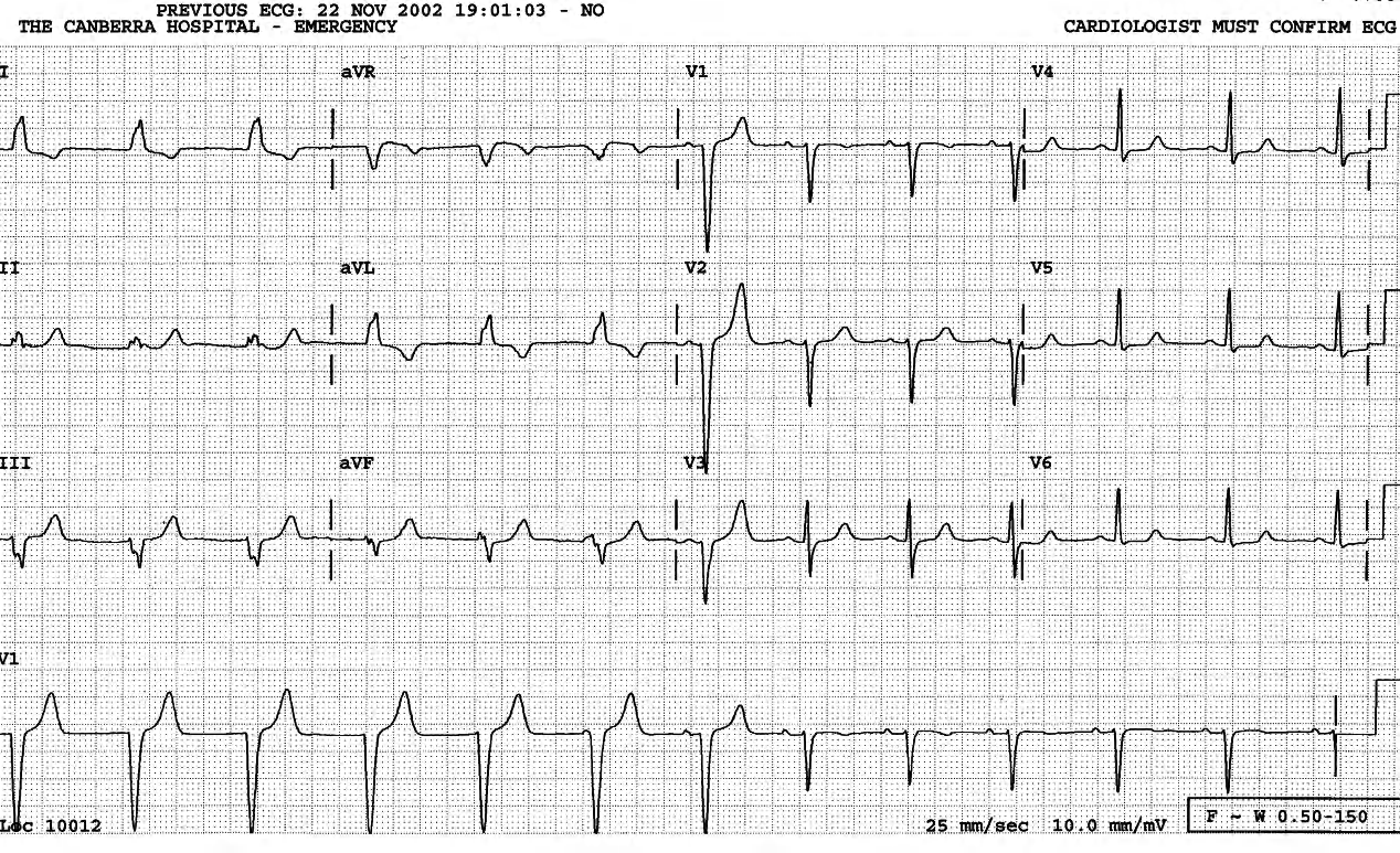 52 year old lady in Casualty, on chronic digoxin therapy for recurrent SVT. There is no structural heart disease. 