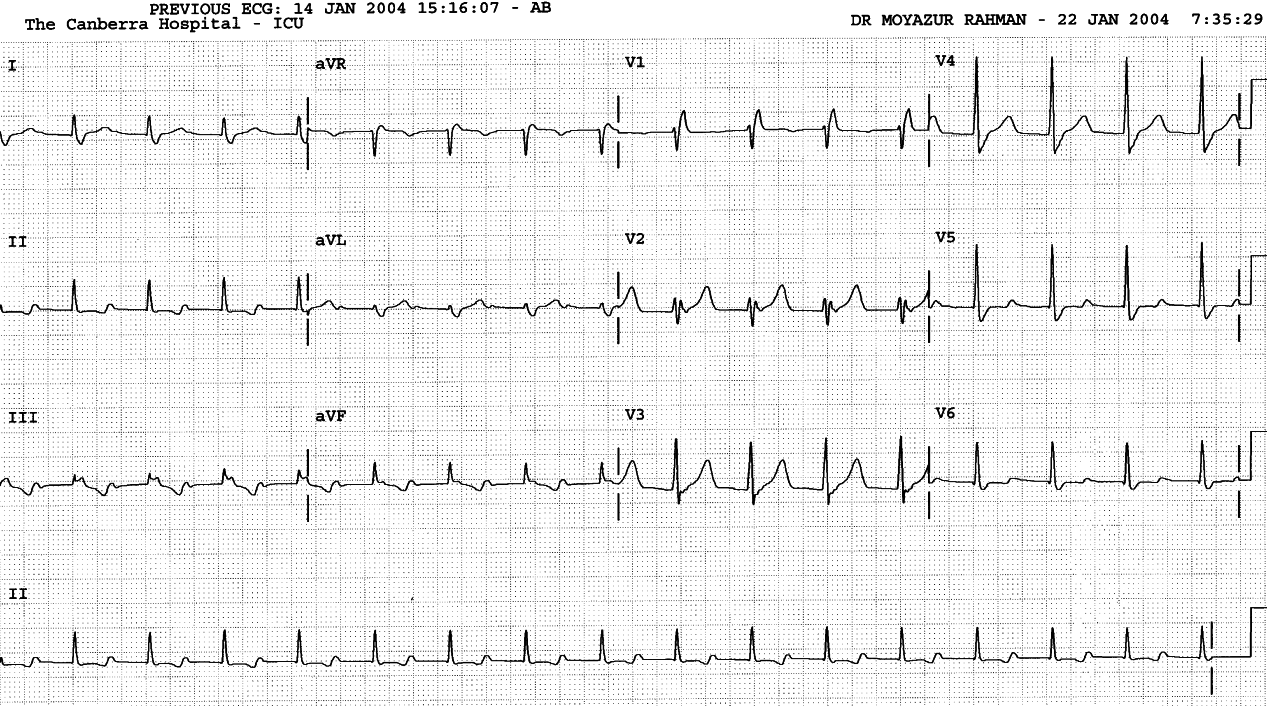 The immediate postoperative trace. First degree block is quite marked. 