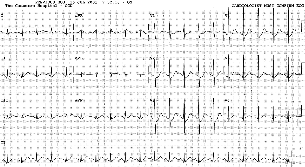 Acute true posterior infarction in sinus tachycardia.