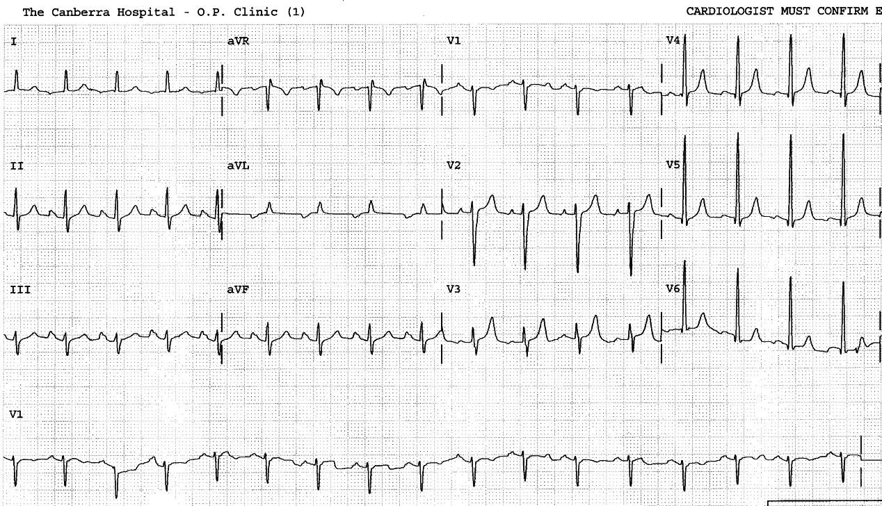 Same atypical P waves four months previously.