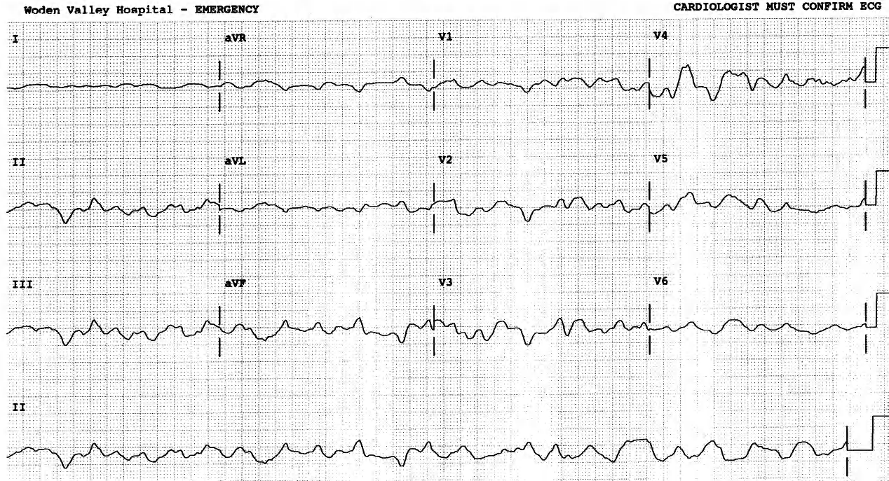 75 year old woman found flat in her flat after not answering her telephone for two days. Her unrecordable blood pressure rose to 70 mmHg following intubation, then disappeared, as the ECG below was being recorded. A Casualty record stated: âNear death on admission.â 