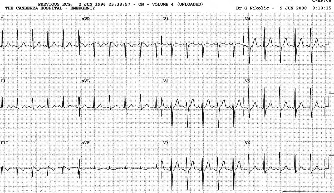 Sinus tachycardia three months earlier. Anxiety? 