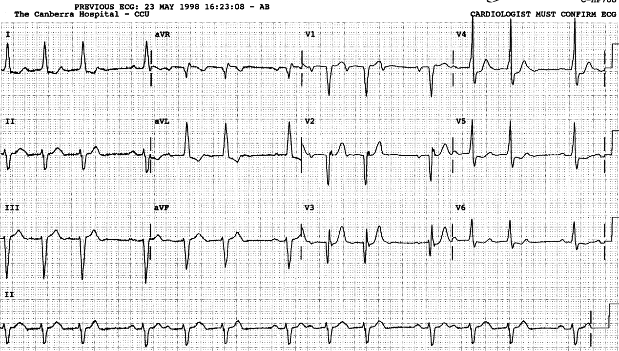 Trigeminy in an 85 year old man with severe triple vessel disease and LV failure. 