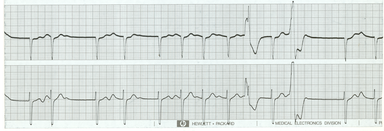 V1-2 strip of a 50 year old man on digoxin and a thiazide diuretic. There are some reciprocal changes, but not in the usual sense.