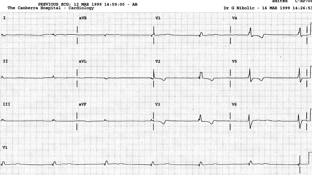 Geriatric Ebstein. Unfortunately sinus P waves are missing.