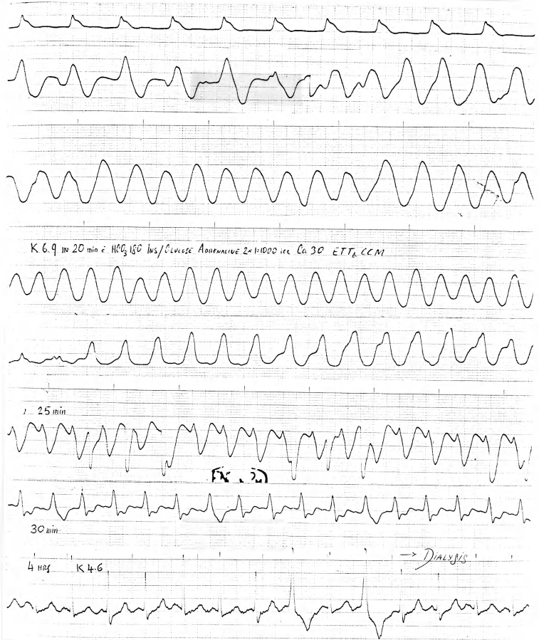 65 year old man with acute-on-chronic renal failure following a gastrectomy. Potassium was 7.9 mEq/L when he arrested, but rising. 