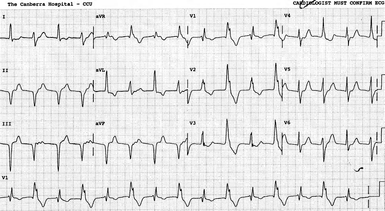 67 year old man with acute inferior infarction. 