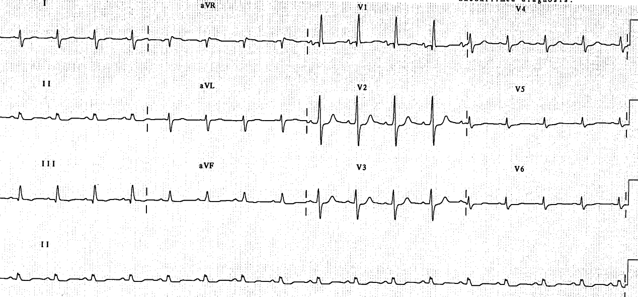 75 year old lady with severe, fatal pulmonary hypertension