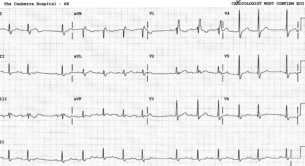 79 year old man with calcified mitral annulus and incompetence requiring mitral valve replacement four days previously. 