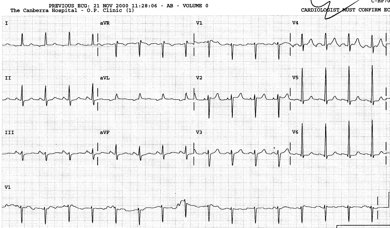 46 year old lady with congestive cardiomyopathy