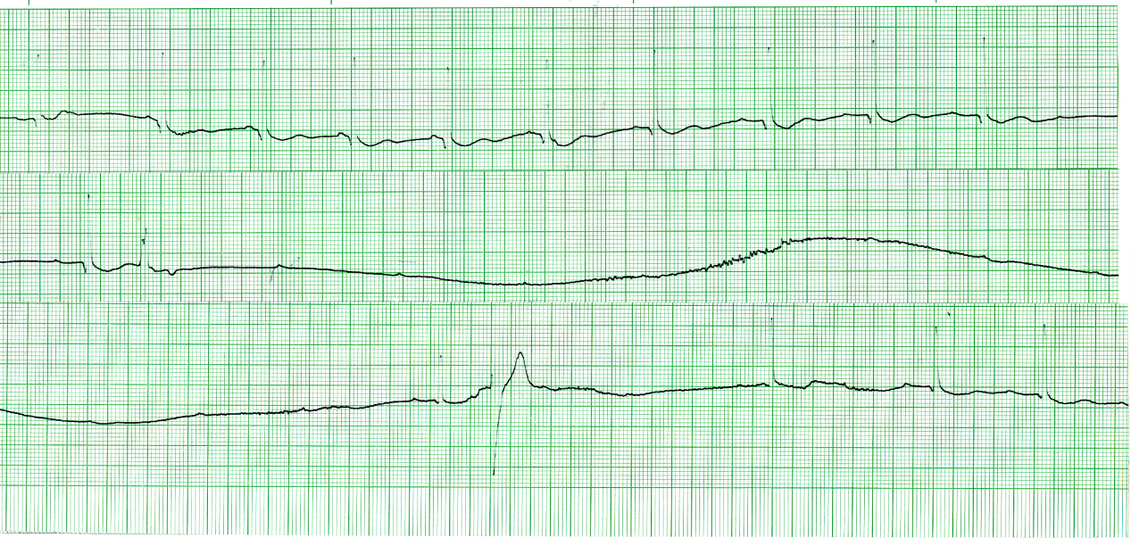 Continuous Holter tracing of a 52 year old woman, on     no cardiac medication, with recent onset of syncopal     attacks. 