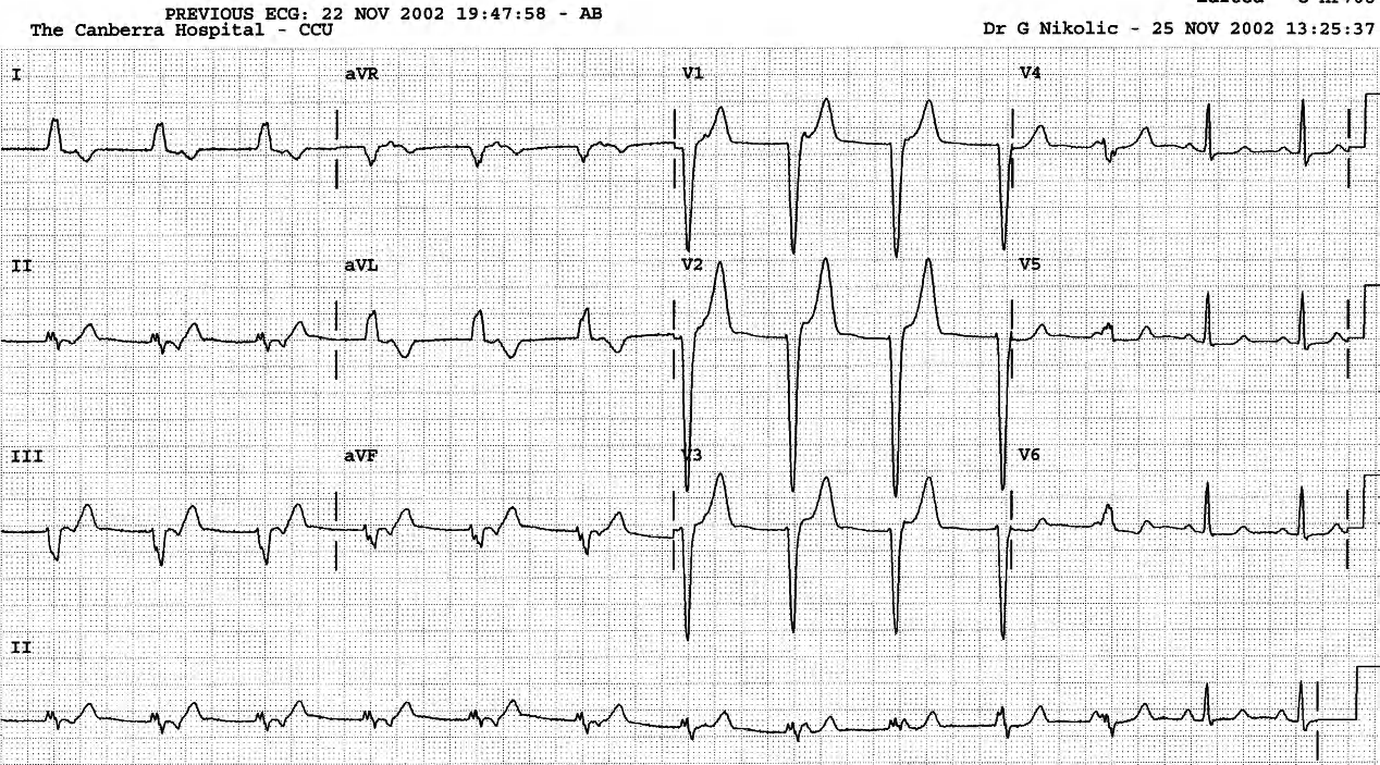 Retrograde conduction of the AIVR until P waves stop it with an atrial fusion beat. 