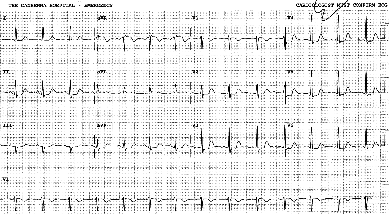 46 year old lady with chest pain.