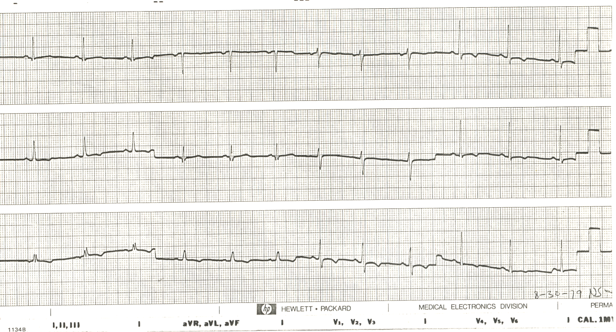 Old pericarditis, historically.