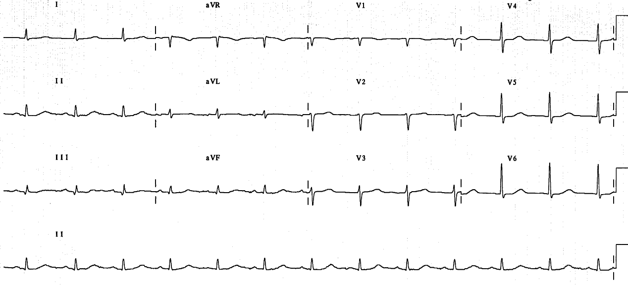 Repeat ECG.