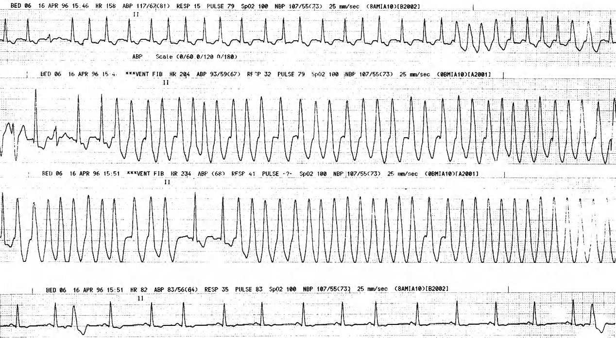 Ventilated 77 year old man with mitral incompetence due to staphylococcal endocarditis, treated with xylocaine by the ICU staff. 