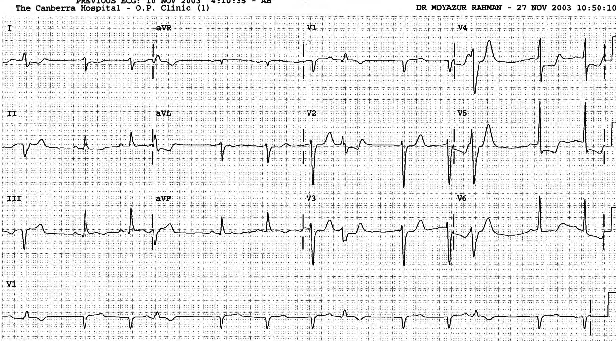 Frequent uniform VEBs in sinus rhythm. The latter is not interrupted and reset â the pauses are (fully) compensatory. 