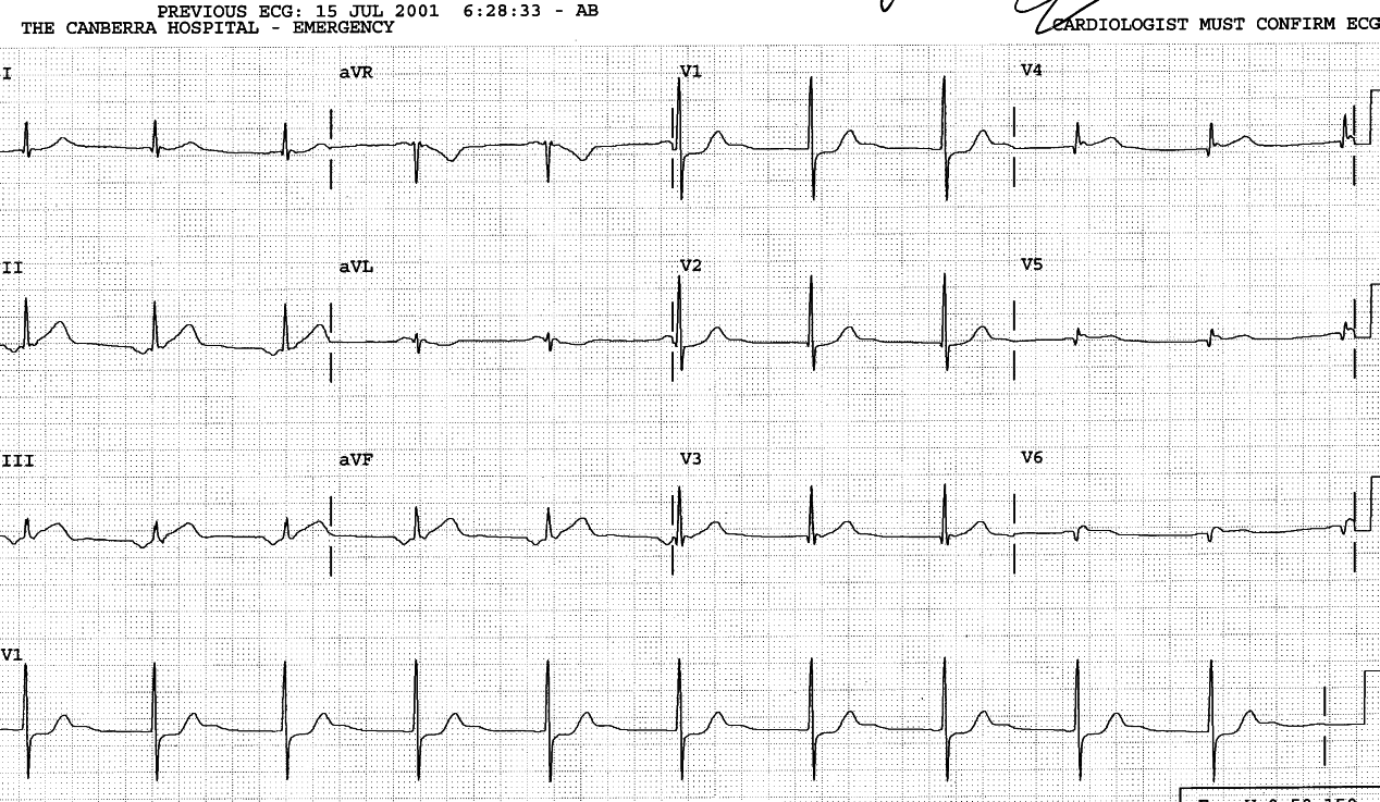 Right-sided V leads documenting RV involvement. Atrial rhythm.