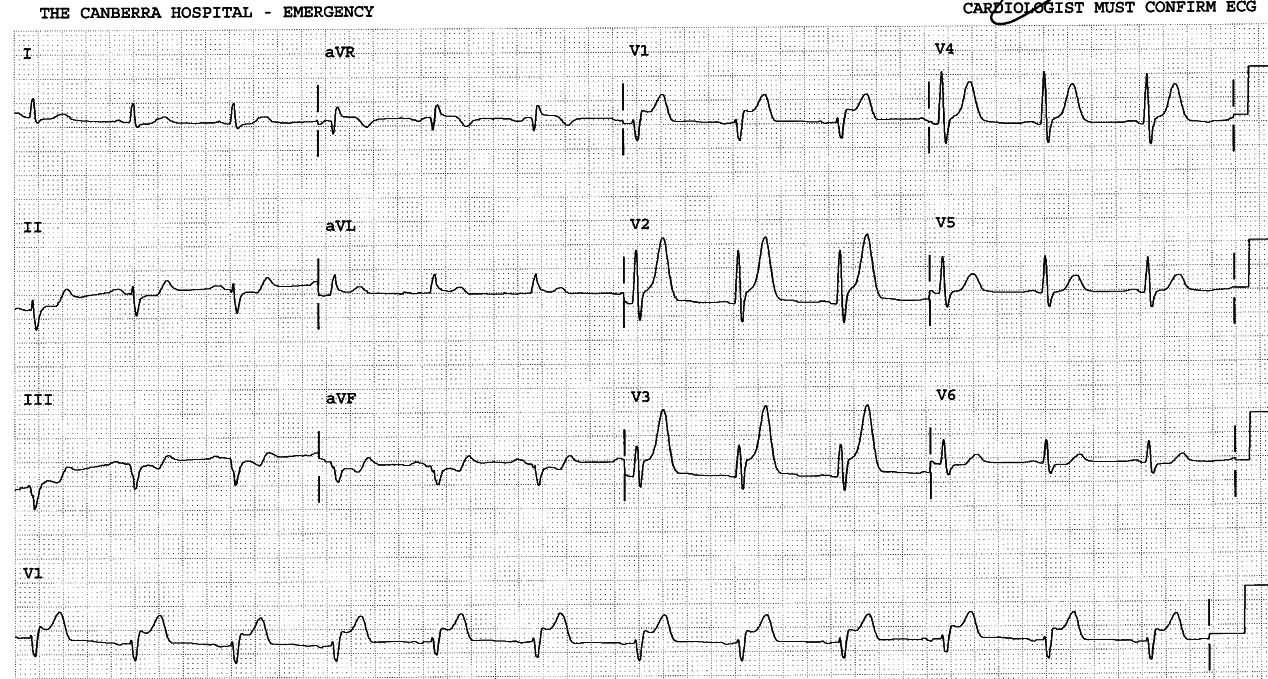 62 year old man with chest pain and history of myocardial infarction.