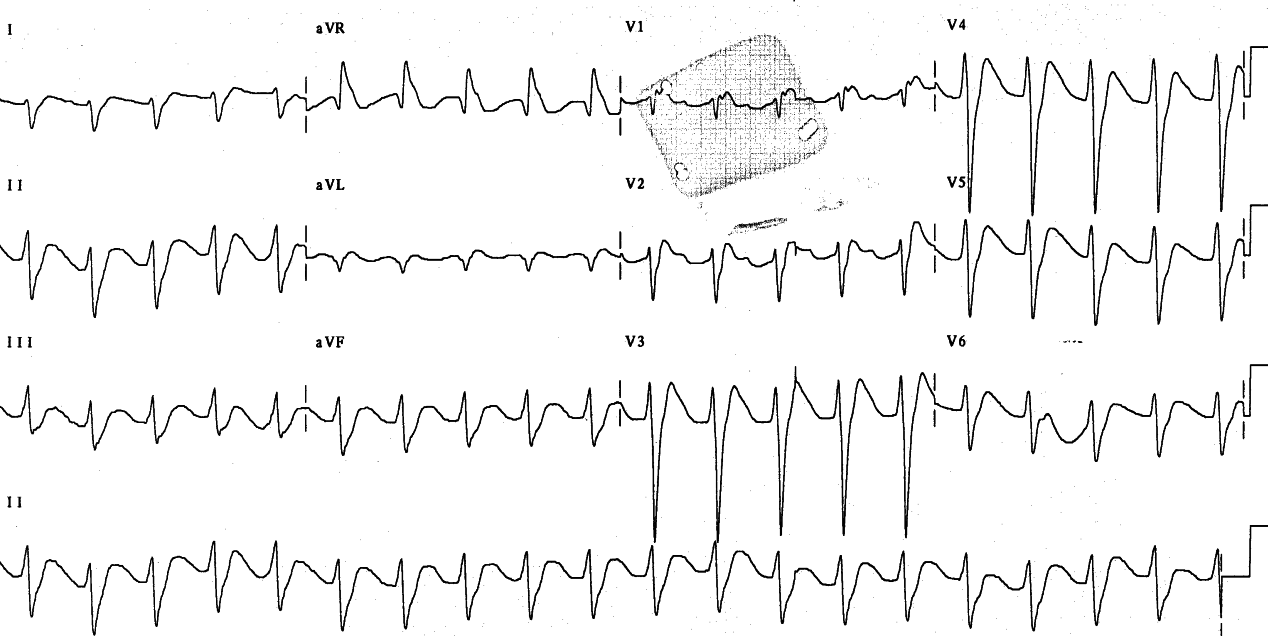 Comatose 24 year man with dextropropoxyphene overdose