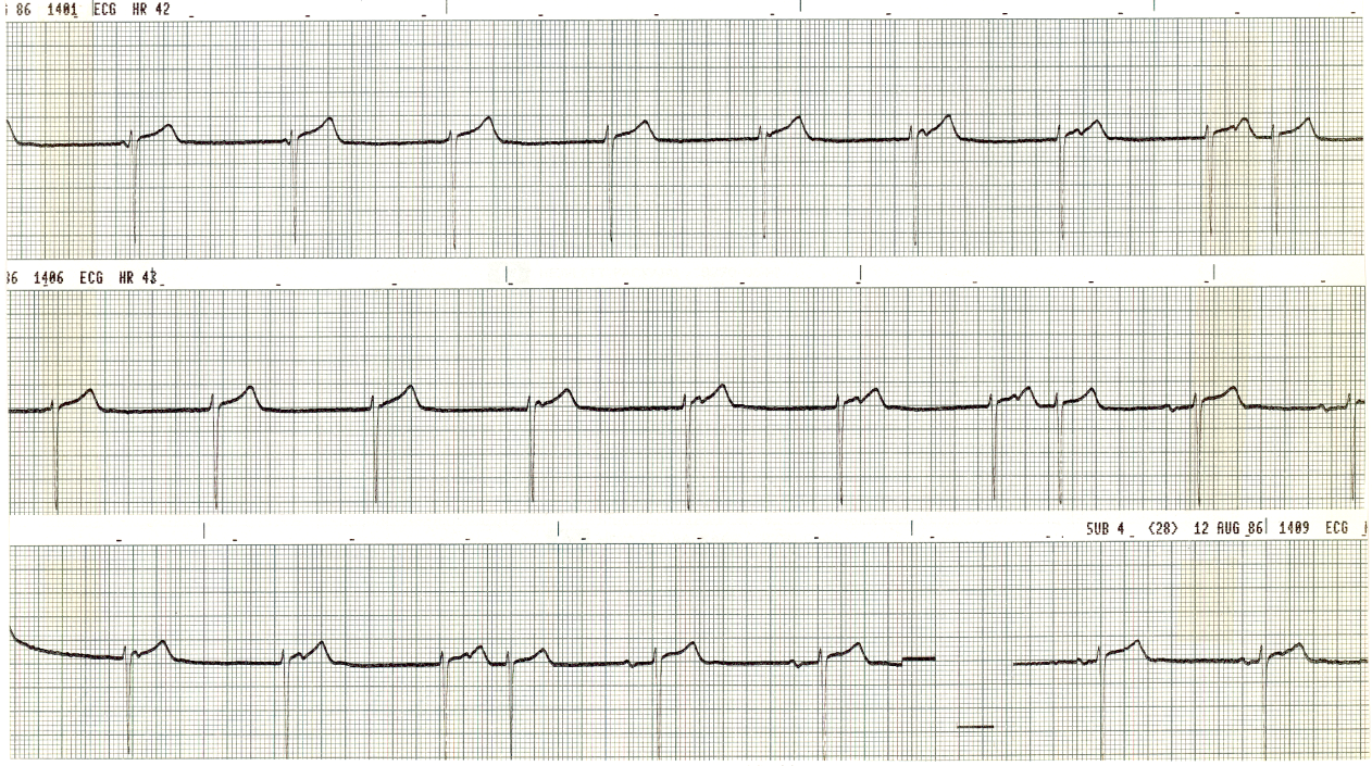 48 year old man on verapamil therapy for hypertension. The strip below was obtained 8 hours after an uneventful carotid endarterectomy. 